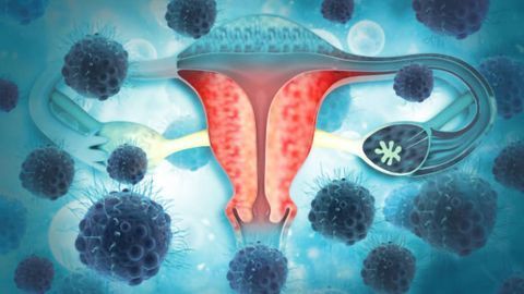 Engineering Adoptive T-Cell Therapy To Overcome Immune Suppression in Ovarian Cancer Engineering Adoptive T-Cell Therapy To Overcome Immune Suppression in Ovarian Cancer