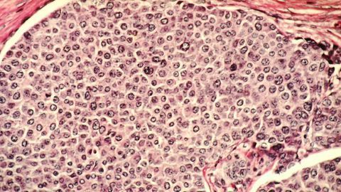 New Approach Kills >95% of Diseased Cells in Mouse Models of Breast Cancer