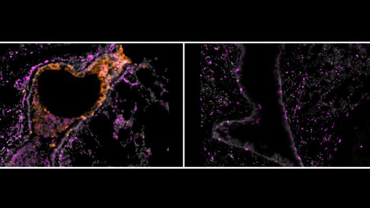 Inhaled Nanobodies: A Potential Treatment for COVID-19