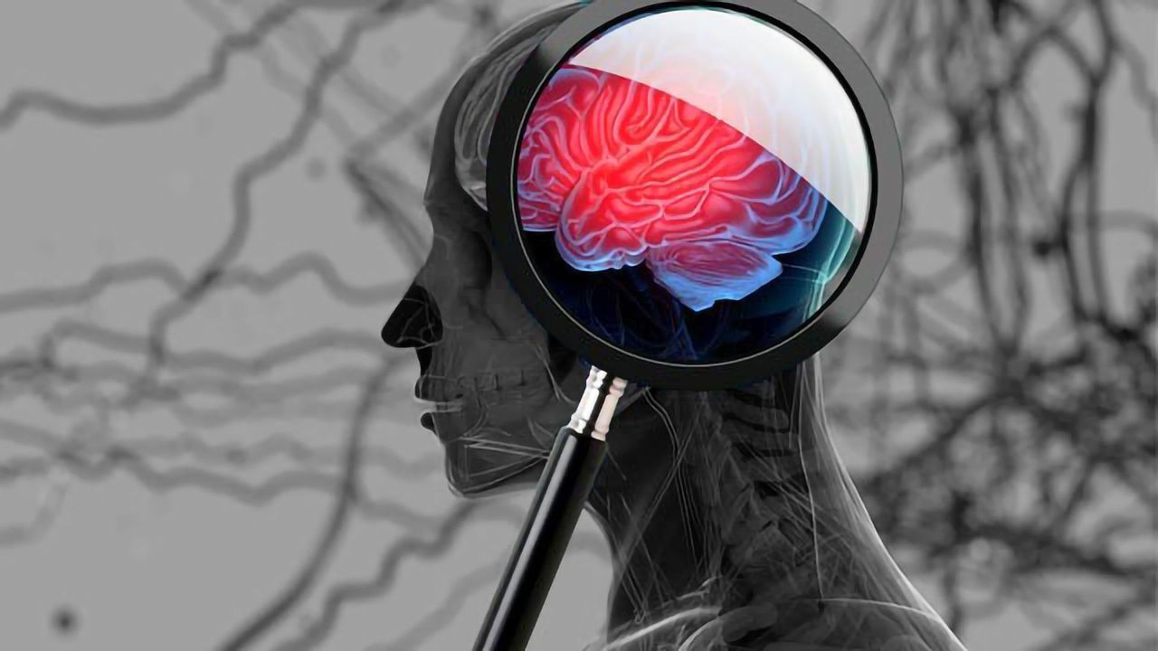 Participation in Professional Rugby May Be Linked to Brain Abnormalities