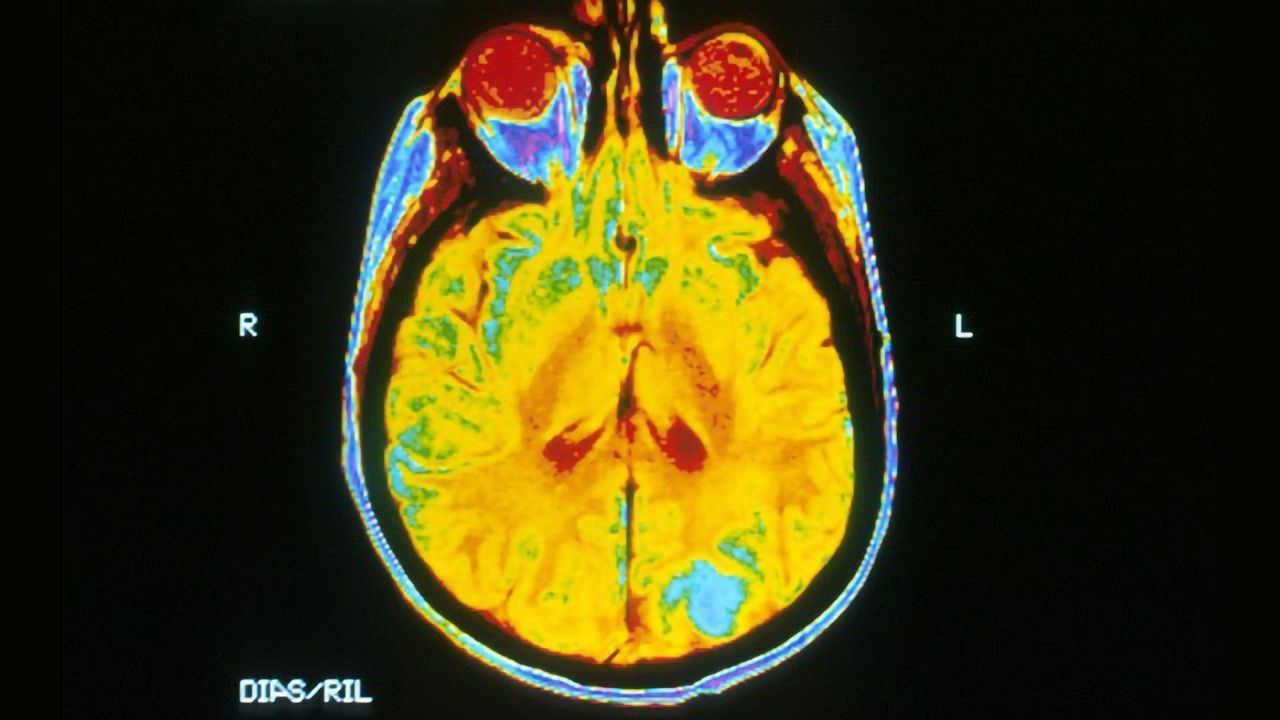 Detecting Brain Tumors Using Patient Urine or Blood Plasma