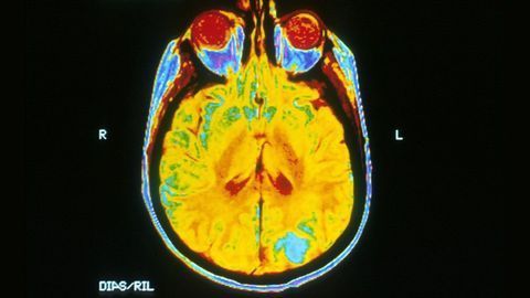Detecting Brain Tumors Using Patient Urine or Blood Plasma