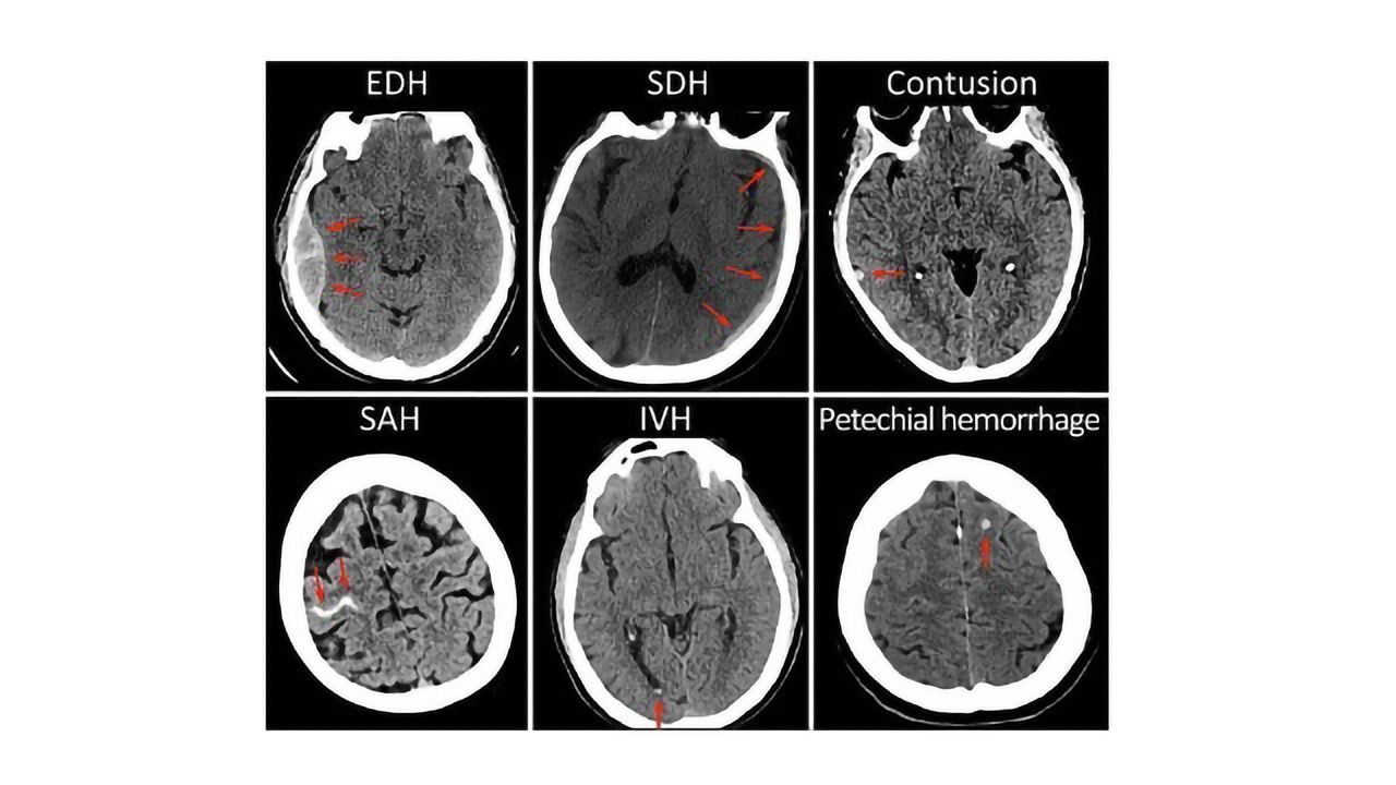 Brain Imaging Could Predict Outcomes of Mild Brain Injury