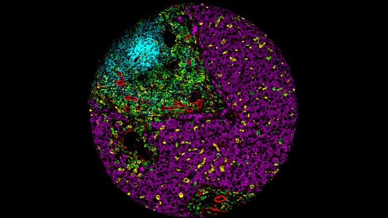 Drug Combo Could Make Surgery Possible for Some Liver Cancer Patients