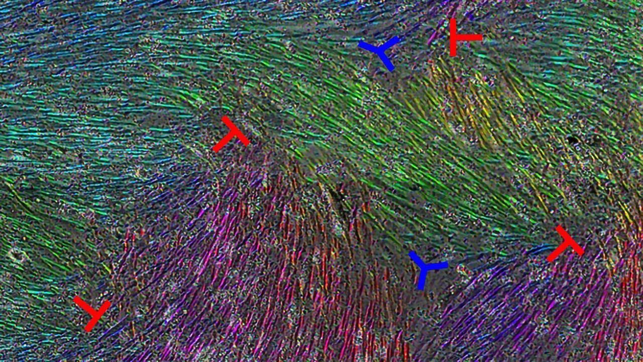 Exploring the Microscopic Defects Causing Ovarian Cancer To Spread