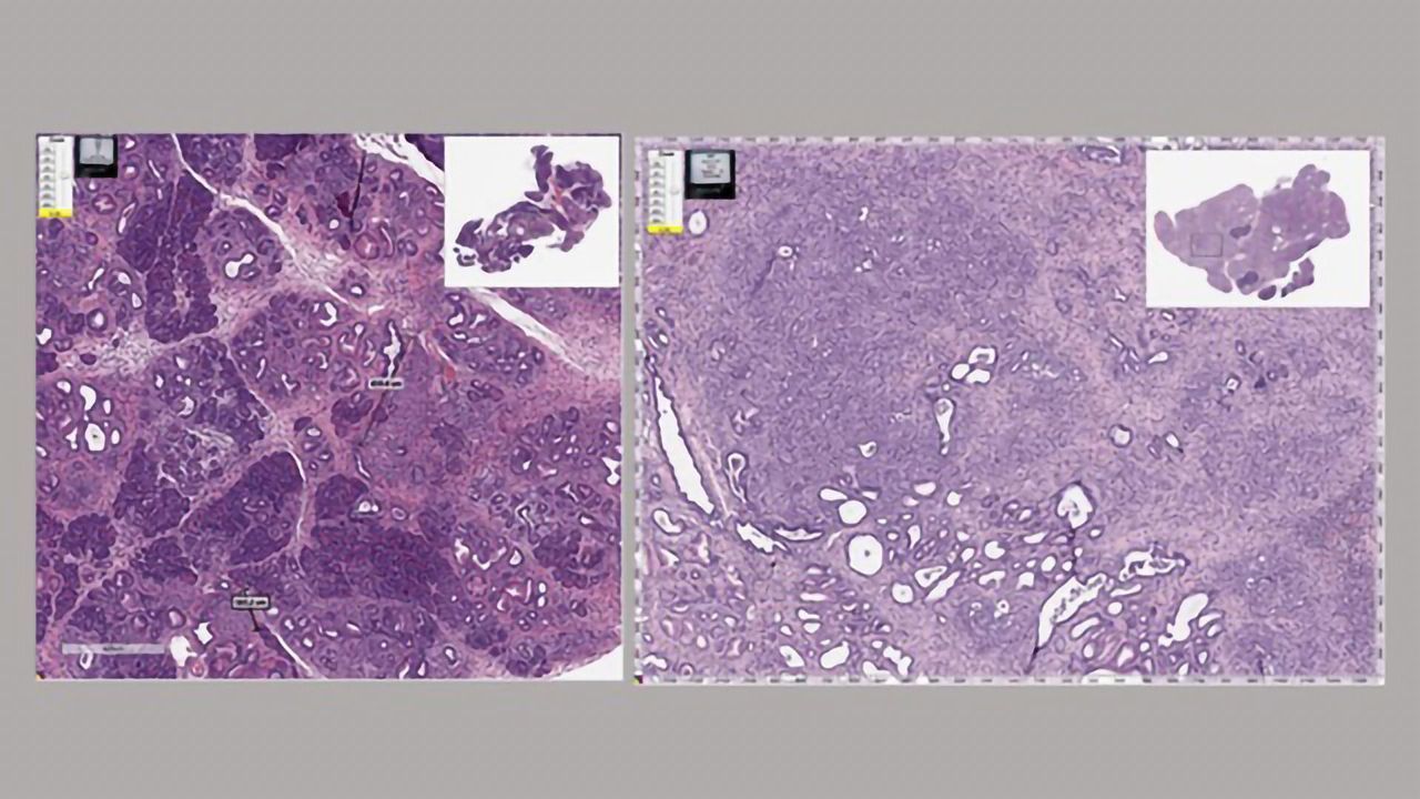 Anti-Parasitic Drug Slows Spread of Pancreatic Cancer in Mouse Model