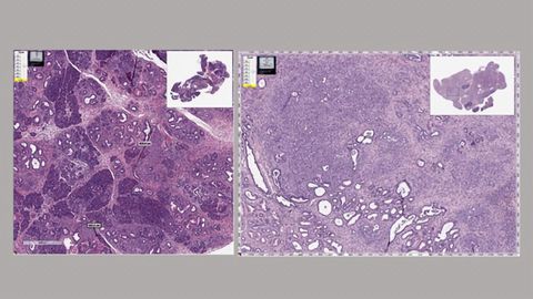 Anti-Parasitic Drug Slows Spread of Pancreatic Cancer in Mouse Model