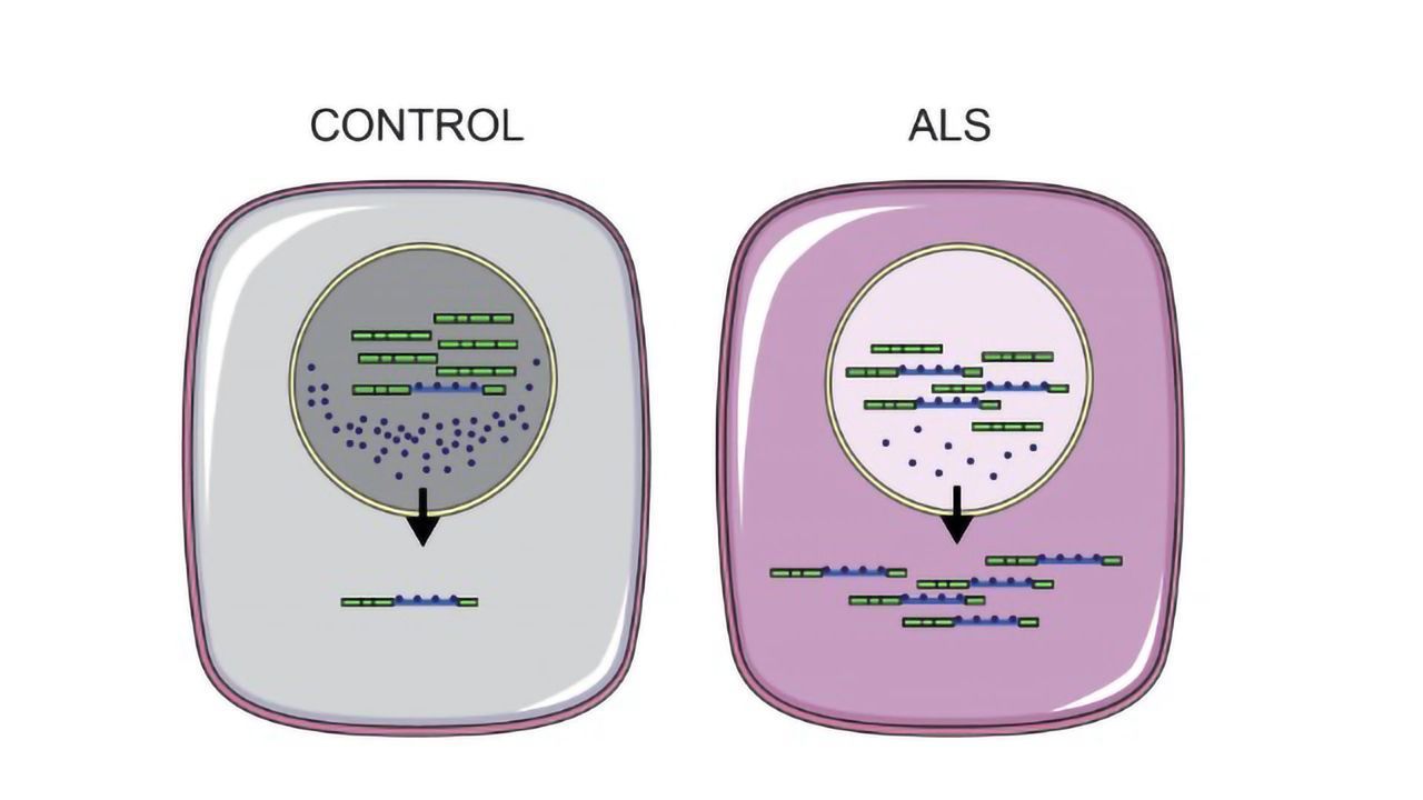 Key ALS Marker Reversed in Stem Cell Study