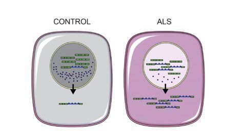 Key ALS Marker Reversed in Stem Cell Study