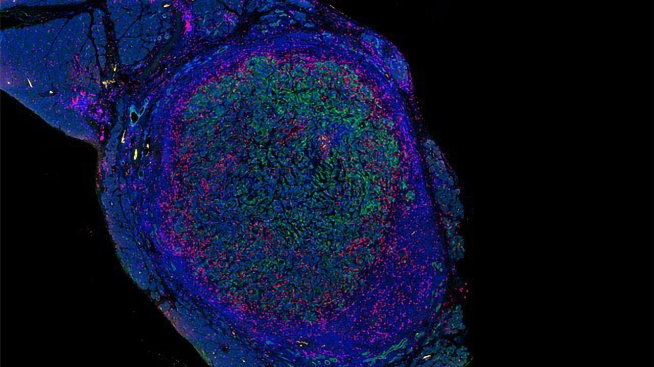 New Drug Combo Eliminates Pancreatic Tumors in Mice