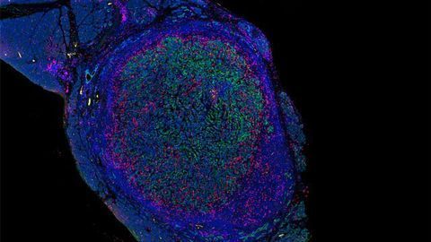 New Drug Combo Eliminates Pancreatic Tumors in Mice