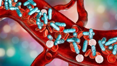 Shedding Light on a Hidden Killer – Why Sepsis Is So Deadly