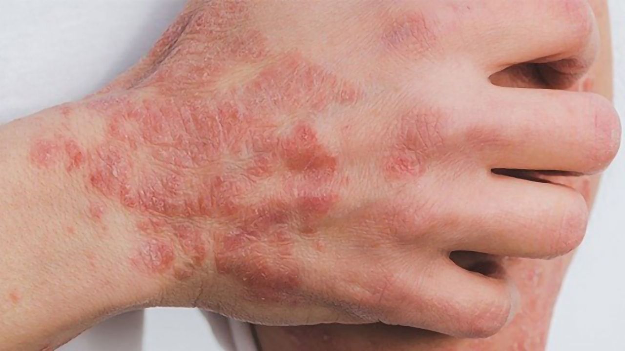 Targeting Skin Protein May Help To Reduce Severity of Psoriasis