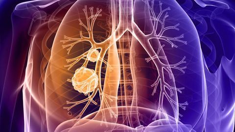 Cell Therapy–Checkpoint Inhibitor Combo Shows Promise in Non-Small Cell Lung Cancer