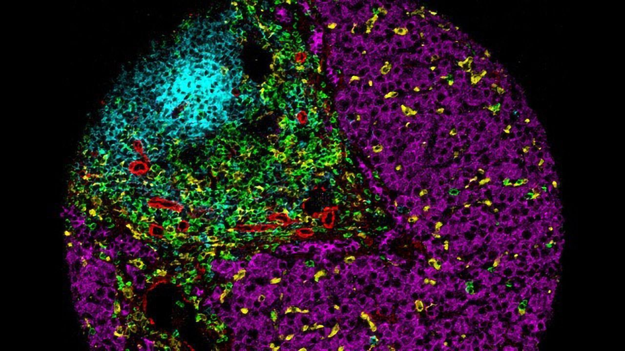 Staining of Immune Tumor
