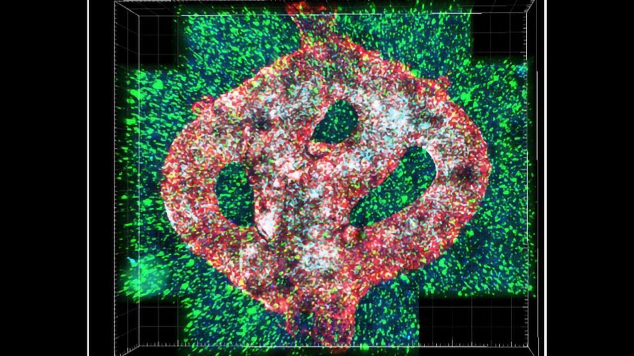 Team 3D Prints an Entire Glioblastoma Tumor
