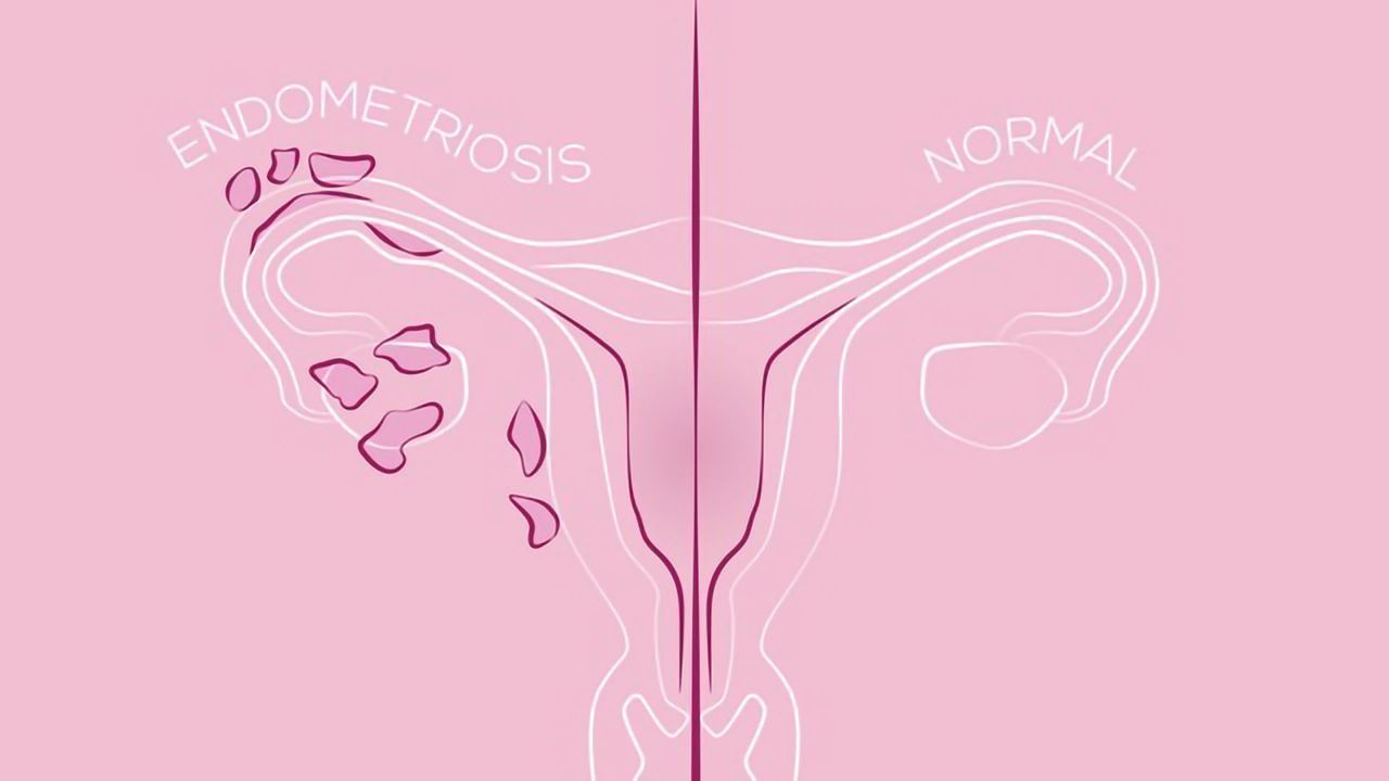 A New Drug Target for Endometriosis Treatment?