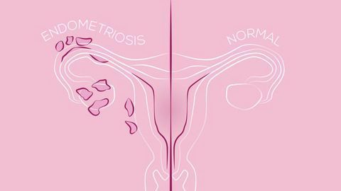 A New Drug Target for Endometriosis Treatment?