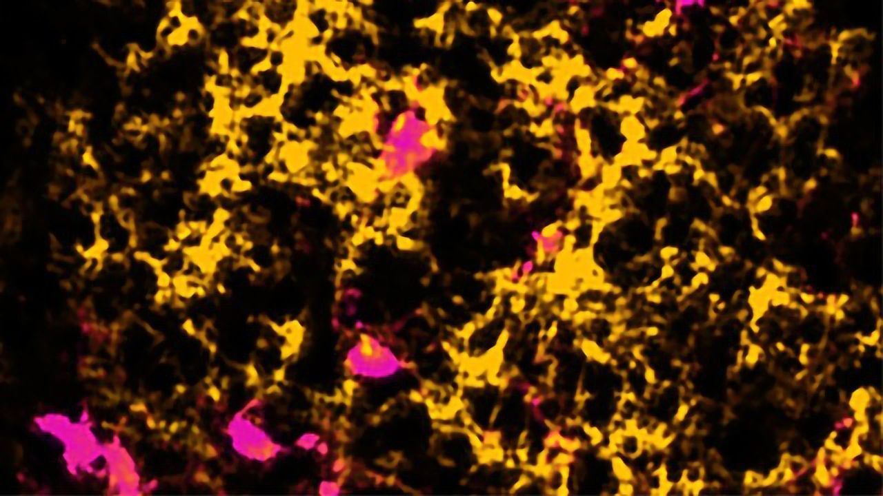 New Line of Drugs Could Help Promote Brain Repair in Multiple Sclerosis