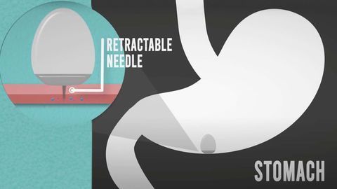 Alternative Delivery Strategy Could Replace Injections for Protein Drugs