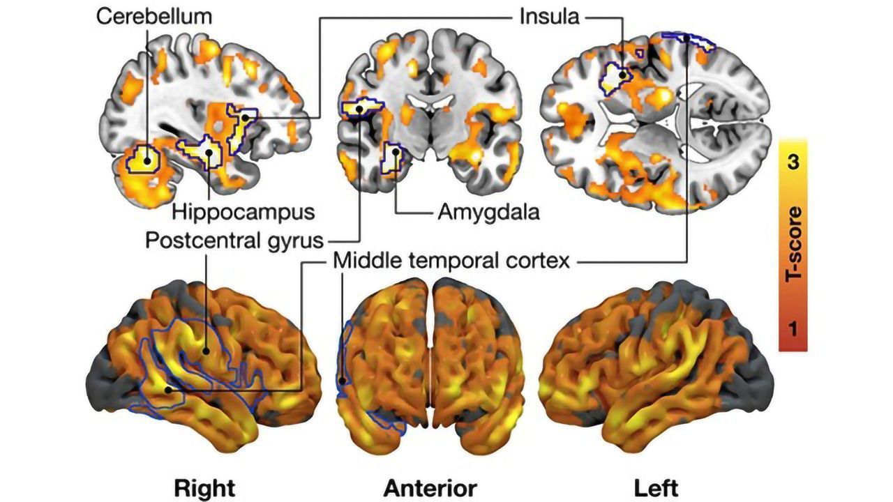Connection Between Brain’s Opioid System and Food Cravings