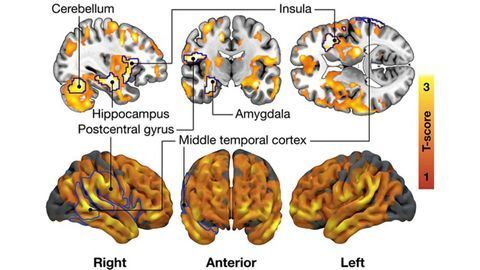 Connection Between Brain’s Opioid System and Food Cravings