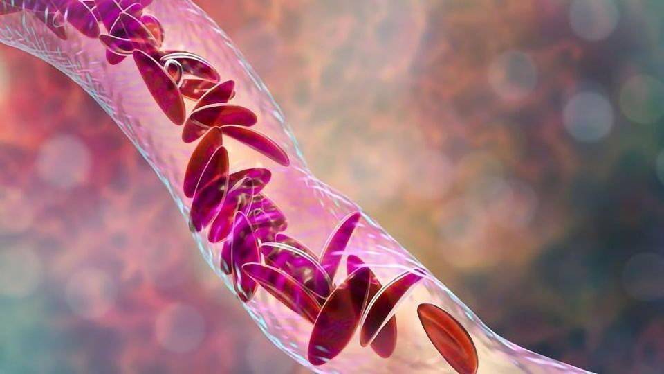 Can CRISPR Cure Sickle Cell Disease? content piece image