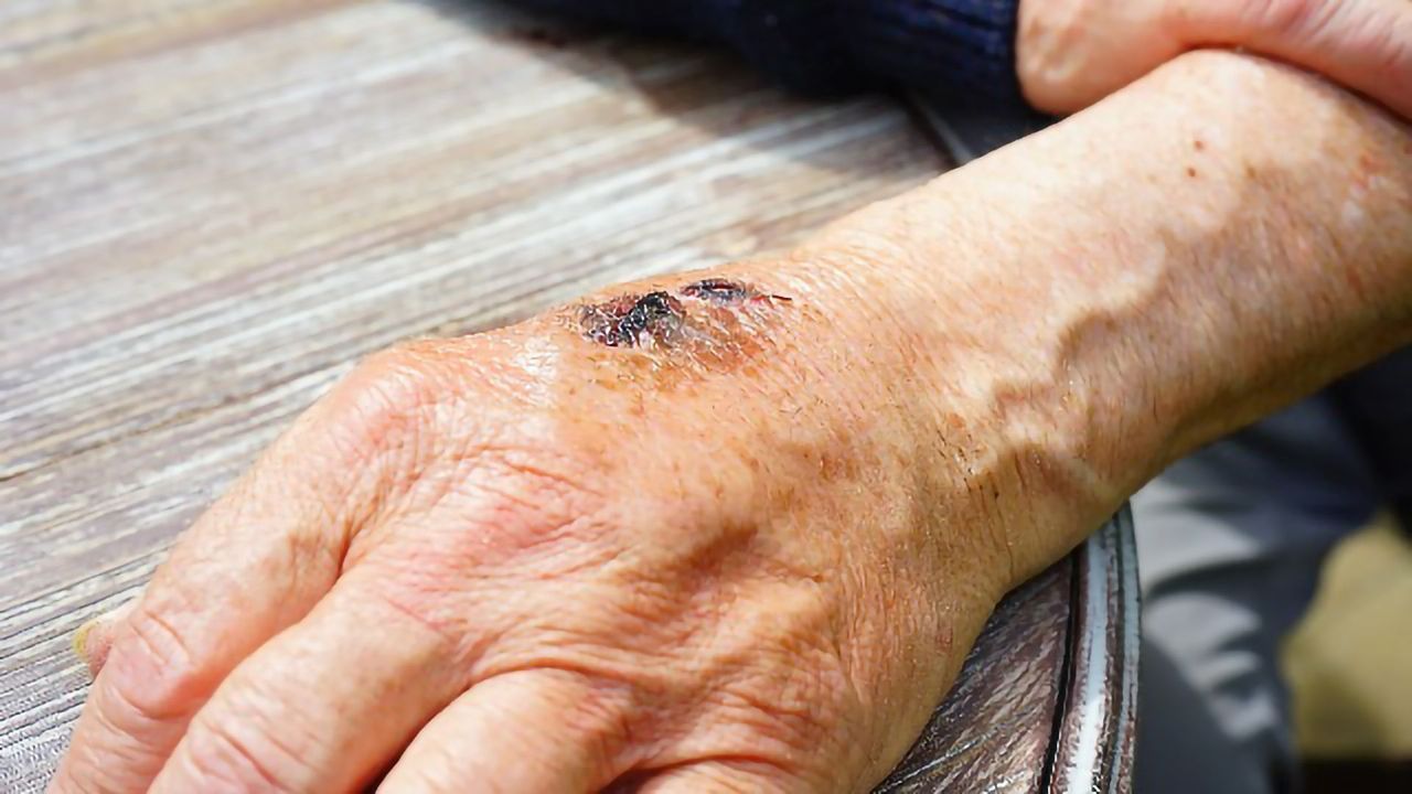 Synthetic Exosomes Can Optimize Wound Healing
