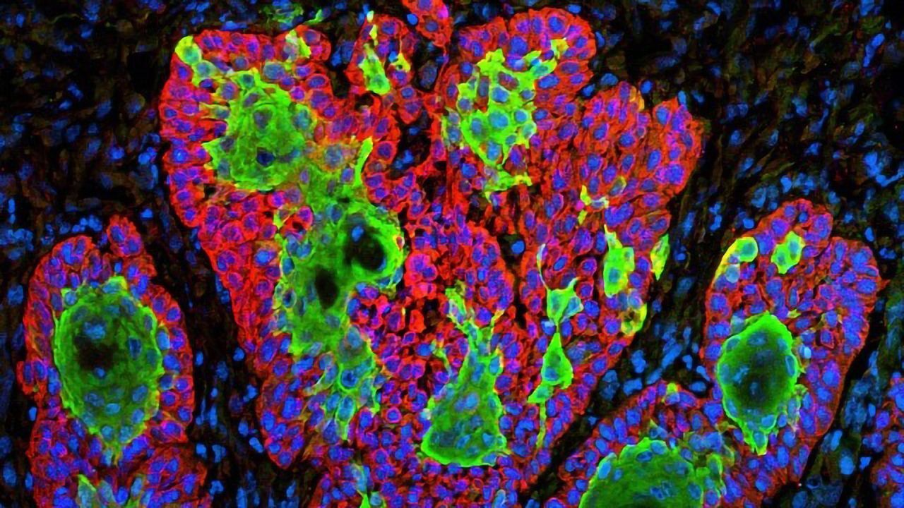 Cellular Spy Helps Skin Cancer Take Hold