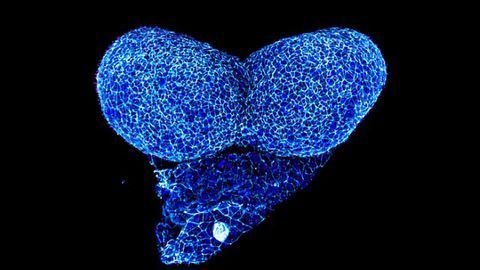Gene Findings Advance Understanding of Rare Brain Disease Holoprosencephaly