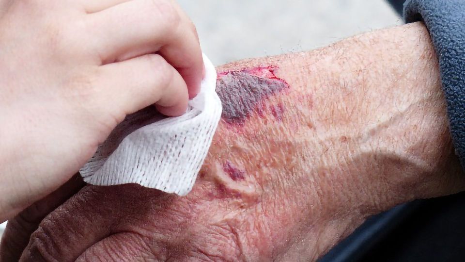 Low Cost Sensors Rapidly Detect Infections in Wounds content piece image