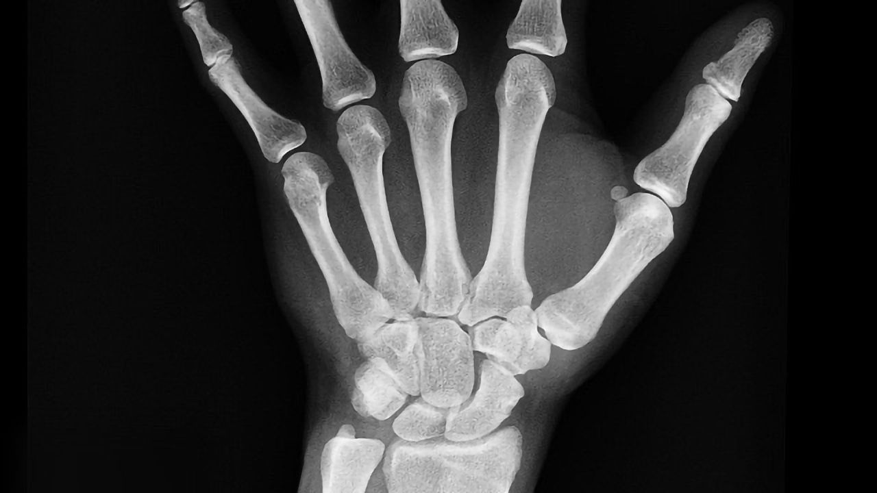 Epigenetic Changes in Old Age Increase Risk of Osteoporosis