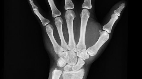Epigenetic Changes in Old Age Increase Risk of Osteoporosis