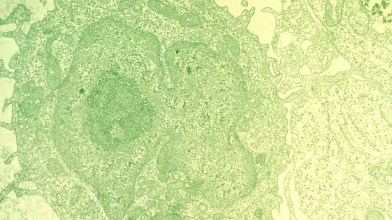 Artificial Intelligence Helps Diagnose Leukemia