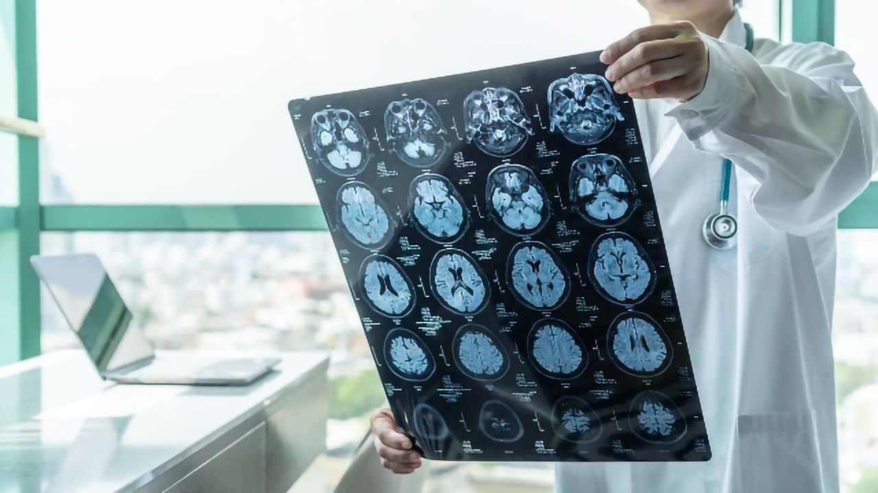 Dementia Symptoms' Appearance Can Be Estimated Via Brain Scan