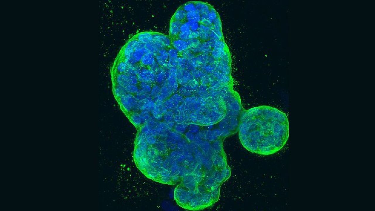 Estrogen Receptor Provides Clues To Overcome Resistance to Anticancer Drugs