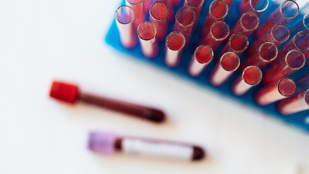 Liquid Biopsy Gives New Insight Into Breast Cancer Prognosis