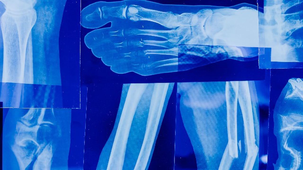 Stem Cell Population Identified That Is Key for Bone Regeneration