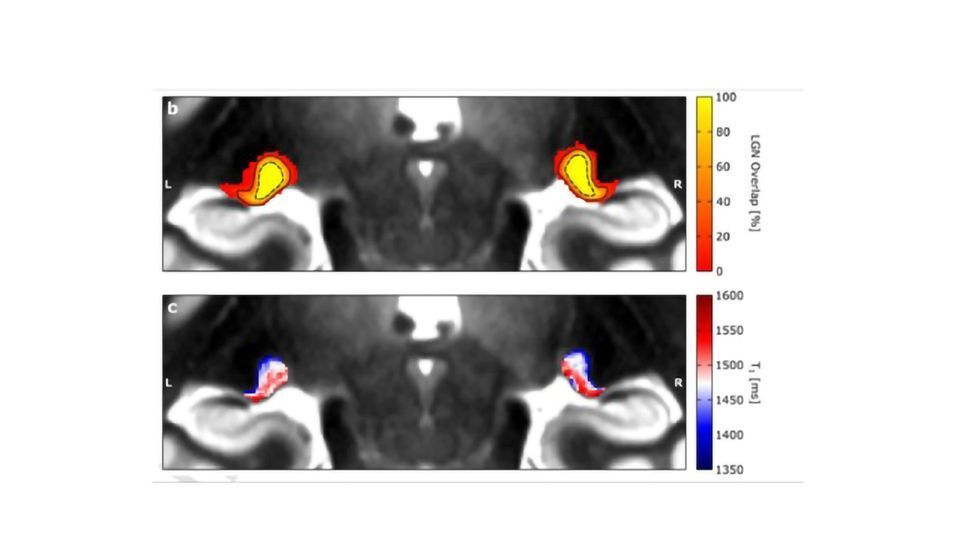 Map of Hidden Brain Region Could Accelerate Dyslexia Research content piece image