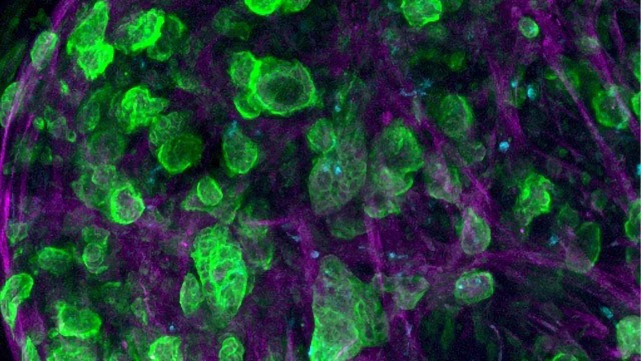 Pancreatic Ductal Adenocarcinoma Cells