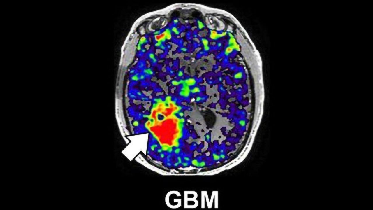 Neuroinflammatory Protein Linked to Worse Glioblastoma Survival in Males