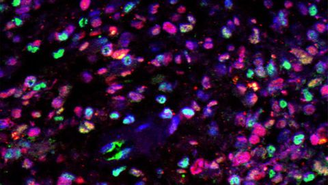 Epigenetic Analysis Reveals Novel Drug Targets for Glioblastoma