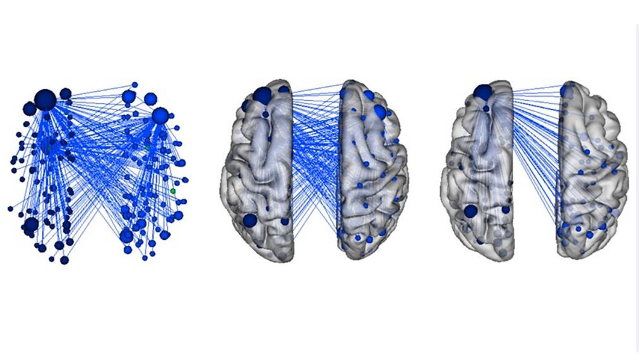 Machine Learning Reveals Aggression Symptoms in Childhood ADHD