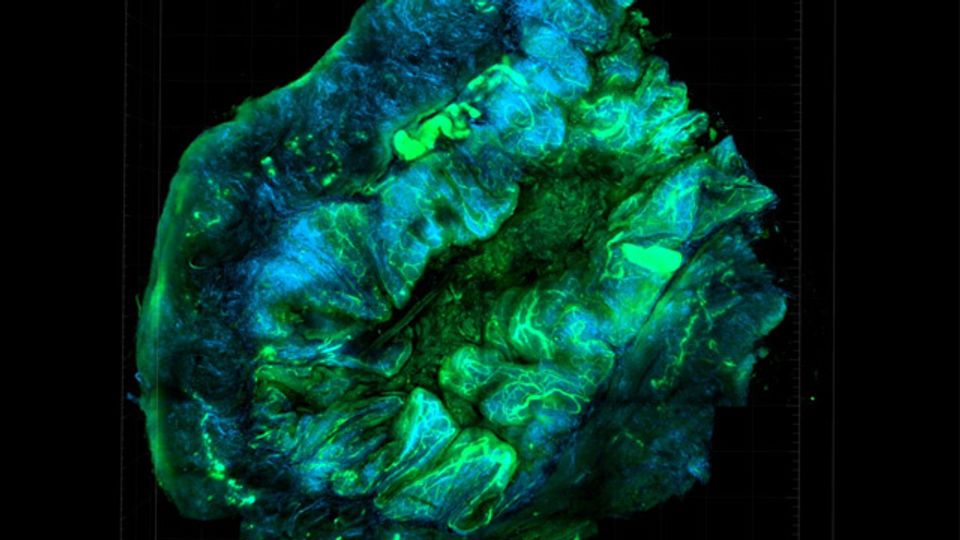 Power of Prediction Drives Advances in Personalized Cancer Medicine content piece image