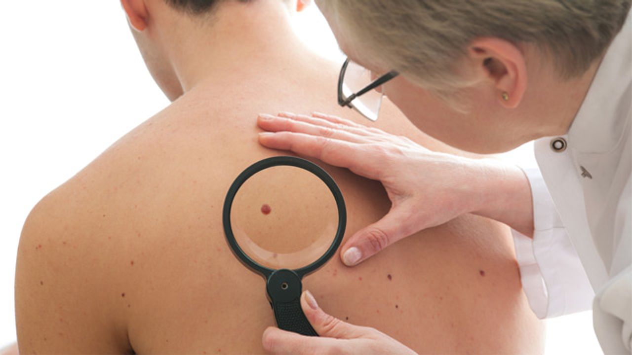 Using Artificial Intelligence To Detect Melanoma