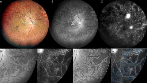 For Diabetes-Related Blindness, Blue Is the Clue