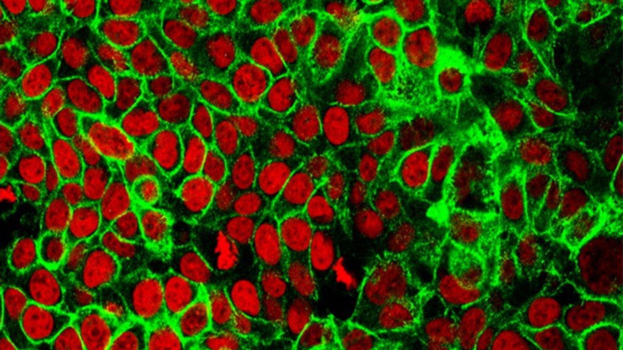 AI Detects Colorectal Cancer From Tissue Scans
