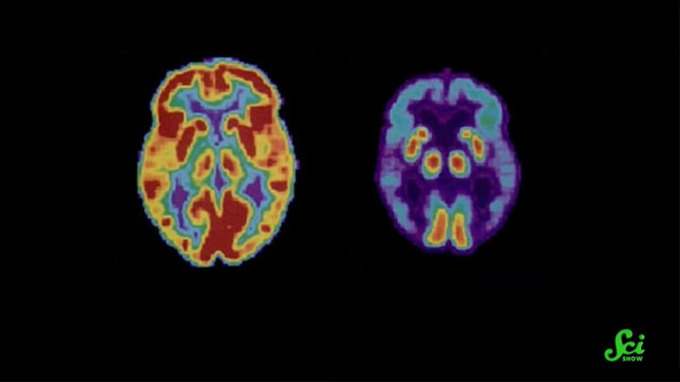 Could We Spot Alzheimer’s Early With RNA?  content piece image
