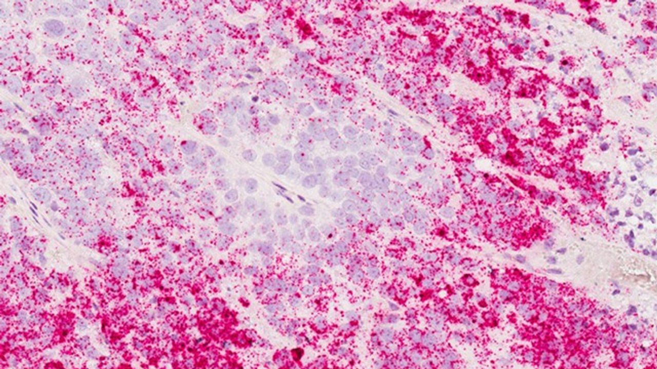 Molecule Blocks Immune Cells From Killing Breast Tumors