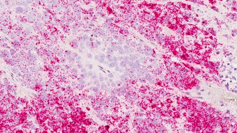 Molecule Blocks Immune Cells From Killing Breast Tumors